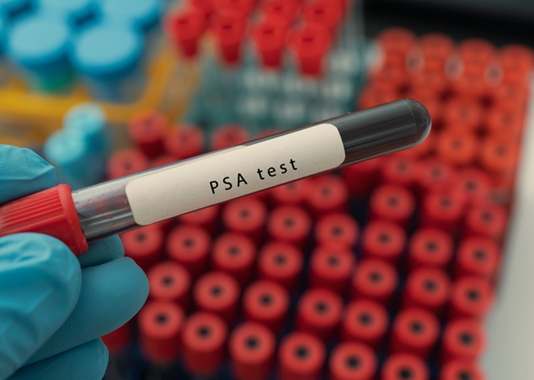 Imagen: El cribado de cáncer de próstata con resonancia magnética de primera línea es menos rentable que las pruebas de PSA de primera línea (foto cortesía de las acciones de Adobe)
